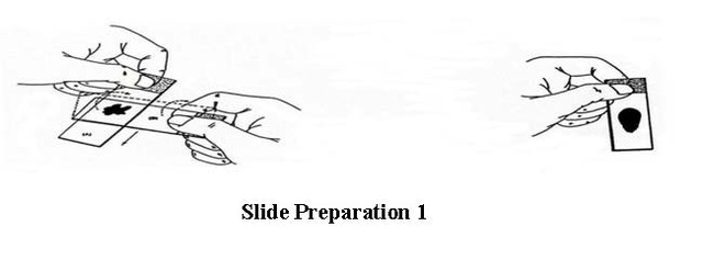 Fine-needle aspiration - Mayo Clinic